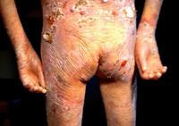 大疱性表皮松解 大疱性表皮松解