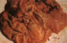 胃神经官能症(图7) 胃神经官能症(图7)