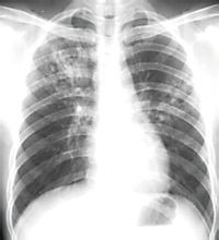 肺热图片