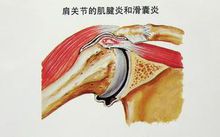 滑囊炎 滑囊炎