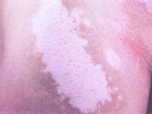 皮肤白斑 皮肤白斑