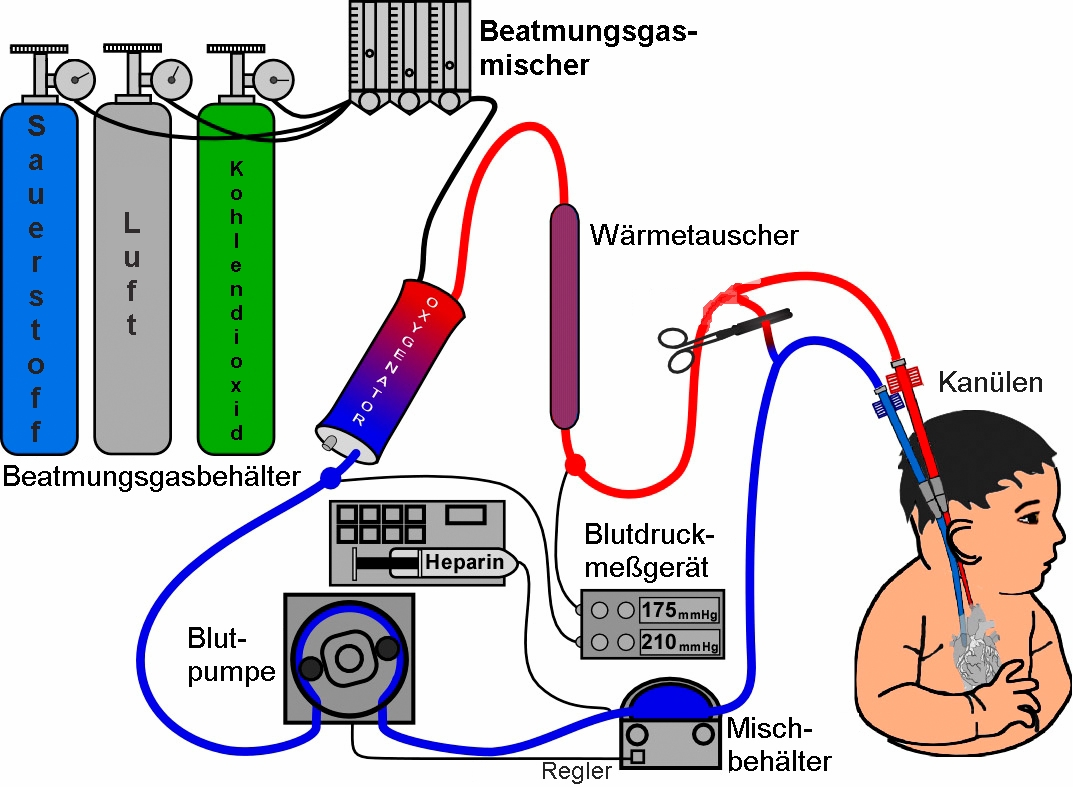 extracorporeal membrane oxygenation